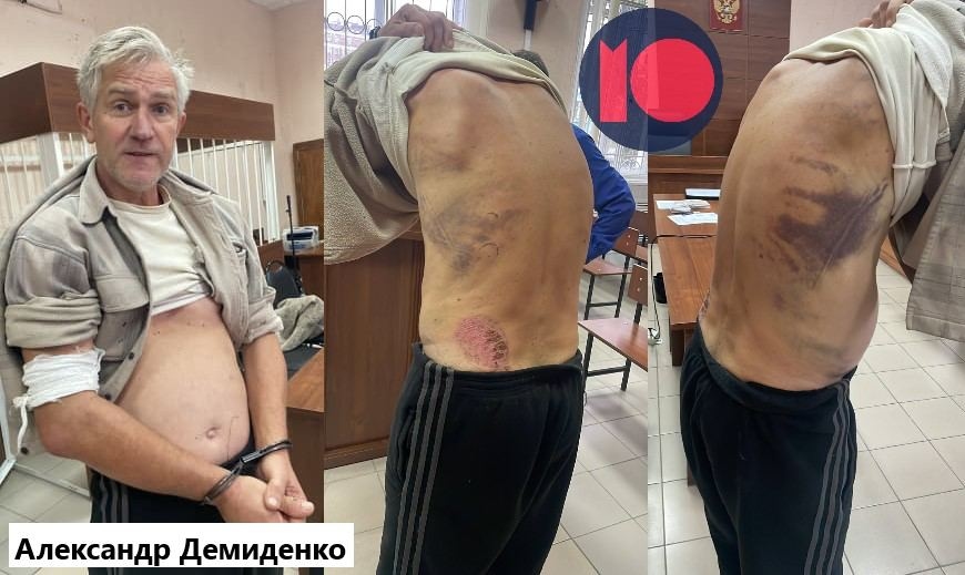 Следы избиений на теле Александра Демиденко